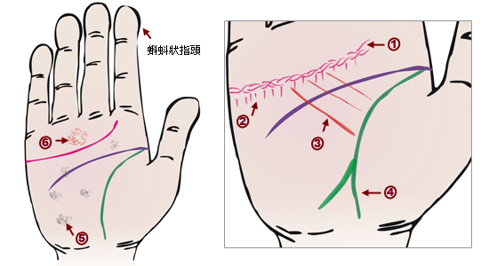 掌紋分析：心臟病掌徵