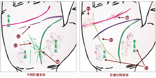 掌紋分析：肝癌掌徵