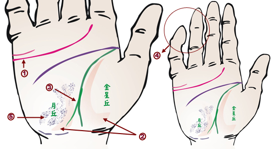掌紋分析：風濕病掌徵
